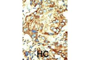 Formalin-fixed and paraffin-embedded human hepatocellular carcinoma tissue reacted with the primary antibody, which was peroxidase-conjugated to the secondary antibody, followed by DAB staining. (Dnmt2 抗体  (AA 353-383))