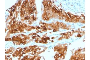 Formalin-fixed, paraffin-embedded human Urothelial Carcinoma stained with Uroplakin 1A Mouse Monoclonal Antibody (UPK1A/2921).