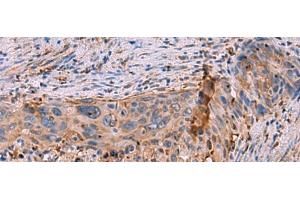 Immunohistochemistry of paraffin-embedded Human cervical cancer tissue using KBTBD11 Polyclonal Antibody at dilution of 1:35(x200) (KBTBD11 抗体)