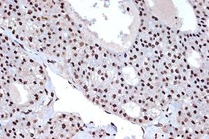 Immunohistochemistry of paraffin-embedded human liver cancer using macroH2A. (H2AFY 抗体)