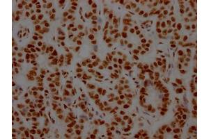IHC image of ABIN7127643 diluted at 1:100 and staining in paraffin-embedded human breast cancer performed on a Leica BondTM system. (Recombinant NONO 抗体)