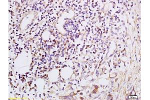 Formalin-fixed and paraffin embedded Human esophageal carcinoma labeled with Anti-CXCL5 Polyclonal Antibody, Unconjugated (ABIN741900) at 1:200, followed by conjugation to the secondary antibody and DAB staining (CXCL5 抗体  (AA 51-132))