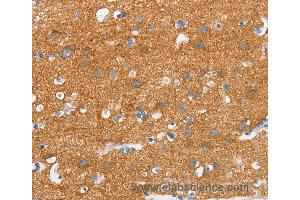 Immunohistochemistry of Human thyroid cancer using SNCA Polyclonal Antibody at dilution of 1:30 (SNCA 抗体)