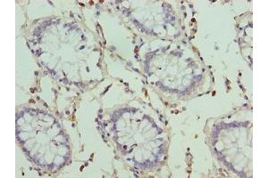 Immunohistochemistry of paraffin-embedded human colon cancer using ABIN7166715 at dilution of 1:100 (HKDC1 抗体  (AA 129-427))