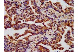IHC image of ABIN7161356 diluted at 1:400 and staining in paraffin-embedded human lung cancer performed on a Leica BondTM system. (CHRNB3 抗体  (AA 67-218))