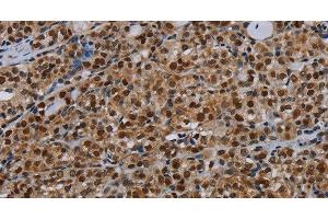 Immunohistochemistry of paraffin-embedded Human thyroid cancer tissue using DCAF6 Polyclonal Antibody at dilution 1:30 (DCAF6 抗体)