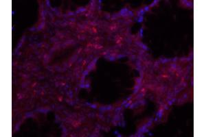 Formalin-fixed and paraffin-embedded human lung carcinoma labeled with Anti-IDO Polyclonal Antibody, Unconjugated (ABIN1714836) 1:200, overnight at 4°C, The secondary antibody was Goat Anti-Rabbit IgG, FITC conjugated used at 1:200 dilution for 40 minutes at 37°C. (IDO1 抗体  (AA 101-200))