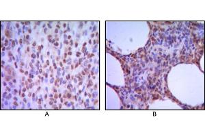 Immunohistochemical analysis of paraffin-embedded human melanoma (A), non-Hodgkin`s lymphoma (B), using MUM1 mouse mAb with DAB staining. (MUM1 抗体)