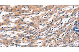 Immunohistochemistry of paraffin-embedded Human liver cancer using RAB18 Polyclonal Antibody at dilution of 1:300 (RAB18 抗体)