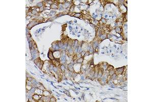 Immunohistochemistry of paraffin-embedded human lung cancer using IL18R1/IL-18 R alpha Rabbit pAb (ABIN3023690, ABIN3023691, ABIN3023692 and ABIN6219764) at dilution of 1:150 (40x lens). (IL18R1 抗体  (AA 19-320))