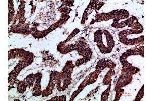 Immunohistochemical analysis of paraffin-embedded human-colon-cancer, antibody was diluted at 1:200. (GREM2 抗体  (AA 71-120))