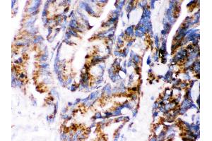 Cathepsin D was detected in paraffin-embedded sections of human Intestinal cancer tissues using rabbit anti- Cathepsin D Antigen Affinity purified polyclonal antibody at 1 μg/mL.