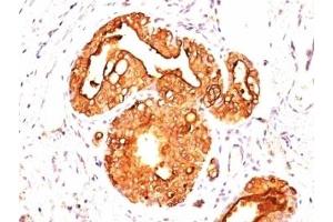 Formalin-fixed, paraffin-embedded human breast carcinoma stained with EMA antibody (MUC1/845). (MUC1 抗体)