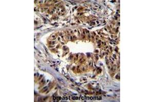 CAD Antibody (Center) immunohistochemistry analysis in formalin fixed and paraffin embedded human breast carcinoma followed by peroxidase conjugation of the secondary antibody and DAB staining. (CAD 抗体  (Middle Region))