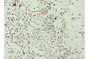 Immunohistochemistry of paraffin-embedded human breast cancer using ABIN7167947 at dilution of 1:100 (GRAF 抗体  (AA 625-814))