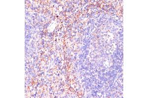 Immunohistochemistry of paraffin-embedded human colon carcinoma using Rap1A antibody (ABIN3021199, ABIN3021200, ABIN3021201 and ABIN6214062) at dilution of 1:100 (40x lens). (RAP1A 抗体  (AA 50-150))