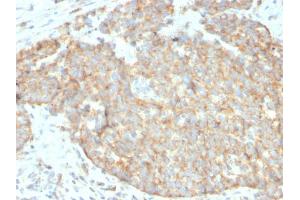 Formalin-fixed, paraffin-embedded human breast carcinoma stained with DR5 Mouse Monoclonal Antibody (DR5/3381).