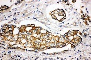 Anti-SPTLC1 antibody, IHC(P) IHC(P): Human Mammary Cancer Tissue (SPTLC1 抗体  (Middle Region))