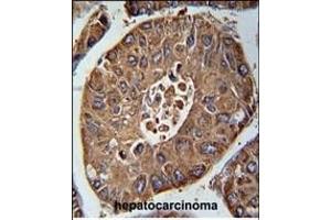 ACN9 Antibody (N-term) (ABIN655002 and ABIN2844636) immunohistochemistry analysis in formalin fixed and paraffin embedded human hepatocarcinoma followed by peroxidase conjugation of the secondary antibody and DAB staining. (ACN9 抗体  (N-Term))