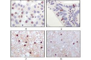Immunohistochemical analysis of paraffin-embedded human liver carcinoma (A), recturn carcinoma (B), normal medulla tissue (C) and normal interbrain tissues (D), showing nuclear localization using Tip60 mouse mAb with DAB staining. (KAT5 抗体)