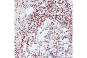 Immunohistochemistry of paraffin-embedded human colon carcinoma using Phospho-CREB1-S133 Rabbit pAb (ABIN3023522, ABIN3023523, ABIN3023524 and ABIN6225375) at dilution of 1:200 (40x lens). (CREB1 抗体  (pSer133))