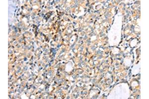 The image on the left is immunohistochemistry of paraffin-embedded Human thyroid cancer tissue using ABIN7191349(MAGEB2 Antibody) at dilution 1/40, on the right is treated with synthetic peptide. (MAGEB2 抗体)