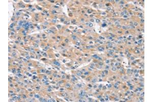The image on the left is immunohistochemistry of paraffin-embedded Human liver cancer tissue using ABIN7192149(RASA3 Antibody) at dilution 1/30, on the right is treated with synthetic peptide. (RASA3 抗体)