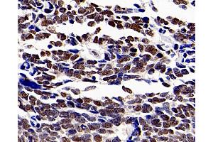 Immunohistochemistry analysis of paraffin-embedded human lung cancer using HDAC1 Polyclonal Antibody at dilution of 1:300. (HDAC1 抗体)