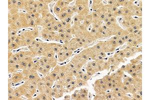 ABIN7094086 and ABIN7098130 at 1/100 staining human liver cancer by IHC-P.