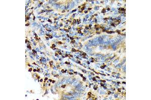 Immunohistochemistry of paraffin-embedded human colon carcinoma using T Rabbit mAb (ABIN7270916) at dilution of 1:100 (40x lens). (TACC3 抗体)