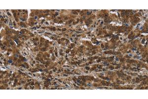 Immunohistochemistry of paraffin-embedded Human liver cancer tissue using PIP Polyclonal Antibody at dilution 1:50 (PIP 抗体)