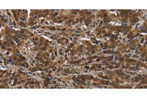 Immunohistochemistry of paraffin-embedded Human liver cancer tissue using PIP Polyclonal Antibody at dilution 1:50 (PIP 抗体)
