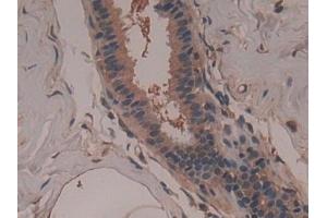 Detection of GARS in Human Breast cancer Tissue using Polyclonal Antibody to Glycyl tRNA Synthetase (GARS) (GARS 抗体  (AA 567-735))