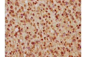 IHC image of nhibHU diluted at 1:5 and staining in paraffin-embedded human glioma cancer performed on a Leica BondTM system. (Histone H2B 抗体  (AA 53-64))