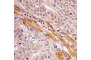 IHC analysis of FFPE human hepatocarcinoma tissue stained with PGK1 antibody (PGK1 抗体  (AA 305-334))