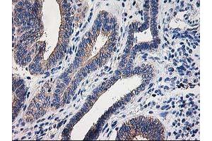 Immunohistochemical staining of paraffin-embedded Adenocarcinoma of Human endometrium tissue using anti-CCM2 mouse monoclonal antibody. (CCM2 抗体)