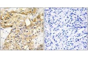 Immunohistochemistry analysis of paraffin-embedded human liver carcinoma tissue, using Collagen XVIII alpha1 Antibody. (COL18A1 抗体  (AA 801-850))