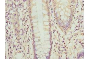 Immunohistochemistry of paraffin-embedded human colon cancer using ABIN7162208 at dilution of 1:100 (Oligophrenin 1 抗体  (AA 1-270))