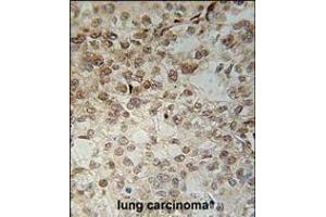 C14orf179 Antibody immunohistochemistry analysis in formalin fixed and paraffin embedded human lung carcinoma followed by peroxidase conjugation of the secondary antibody and DAB staining. (IFT43 抗体  (AA 145-171))