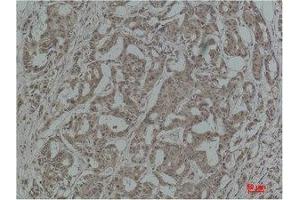 Immunohistochemistry (IHC) analysis of paraffin-embedded Human Breast Carcinoma using Stat3 Polyclonal Antibody.