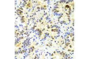 Immunohistochemistry of paraffin-embedded human lung cancer using SRSF1 Antibody (ABIN5970815) at dilution of 1/100 (40x lens). (SRSF1 抗体)