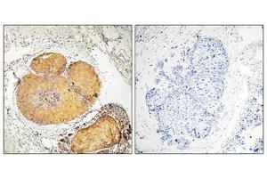 Immunohistochemical analysis of paraffin-embedded human breast carcinoma tissue, using FADD (Phospho-Ser190) antibody (left)or the same antibody preincubated with blocking peptide (right). (FADD 抗体  (pSer191))