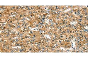 Immunohistochemistry of paraffin-embedded Human liver cancer tissue using RASSF9 Polyclonal Antibody at dilution 1:45