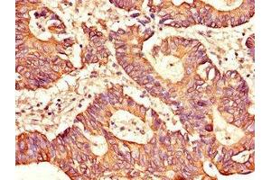 Immunohistochemistry of paraffin-embedded human colon cancer using ABIN7169453 at dilution of 1:100 (SH2D1B 抗体  (AA 1-77))