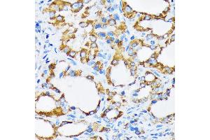 Immunohistochemistry of paraffin-embedded human thyroid cancer using PIST/GOPC Rabbit mAb (ABIN1678809, ABIN1678808, ABIN7101325 and ABIN7101326) at dilution of 1:100 (40x lens). (GOPC 抗体)