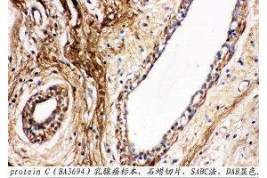 Anti-Protein C antibody, IHC(P) IHC(P): Human Mammary Cancer Tissue (PROC 抗体  (C-Term))