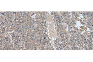 Immunohistochemistry of paraffin-embedded Human liver cancer tissue using USP32 Polyclonal Antibody at dilution of 1:75(x200) (USP32 抗体)