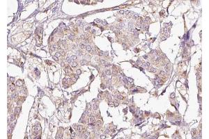 ABIN6267696 at 1/100 staining human Breast cancer tissue sections by IHC-P. (DARPP32 抗体  (pThr75))