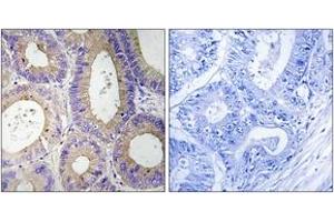 Immunohistochemistry analysis of paraffin-embedded human colon carcinoma tissue, using CBR3 Antibody. (CBR3 抗体  (AA 151-200))