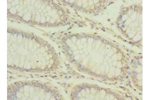 Immunohistochemistry of paraffin-embedded human colon cancer using ABIN7146772 at dilution of 1:100 (CPD 抗体  (AA 860-1100))